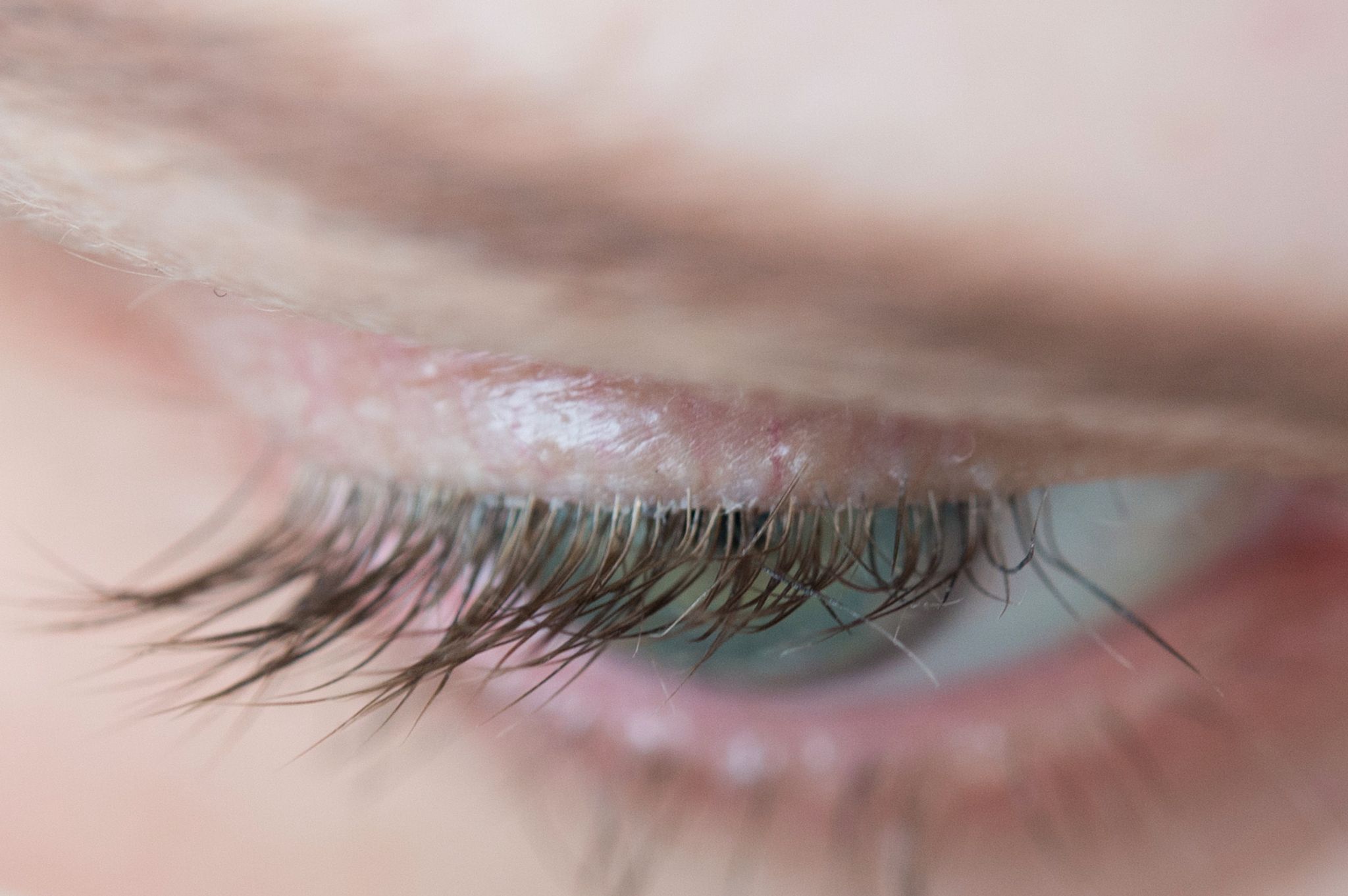 Demodex-Milben können Symptome eines trockenen Auges oder einer Lidrandentzündung auslösen.